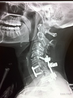 2 over aggressive spine fusion surgeries without patients consent