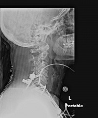 Internal Suturing Stopped Short