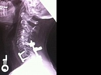 Spine Fused without Lordosis