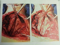 Transferring muscles back after imbricating to the dorsal posterior spine